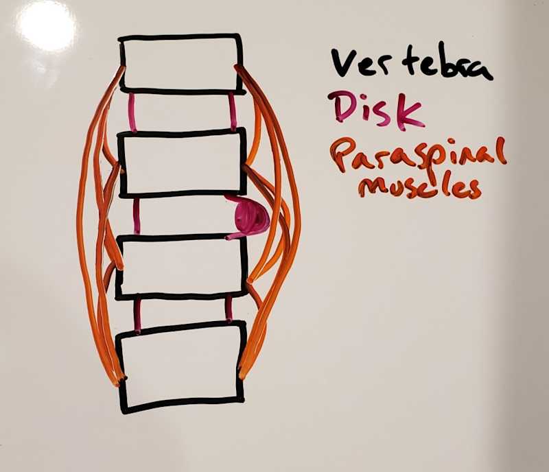 disc herniation