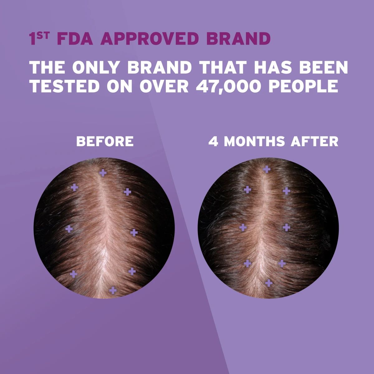 Rogaine-EDIS-R-BeforeAfter-WomansTopical-EDI.webp