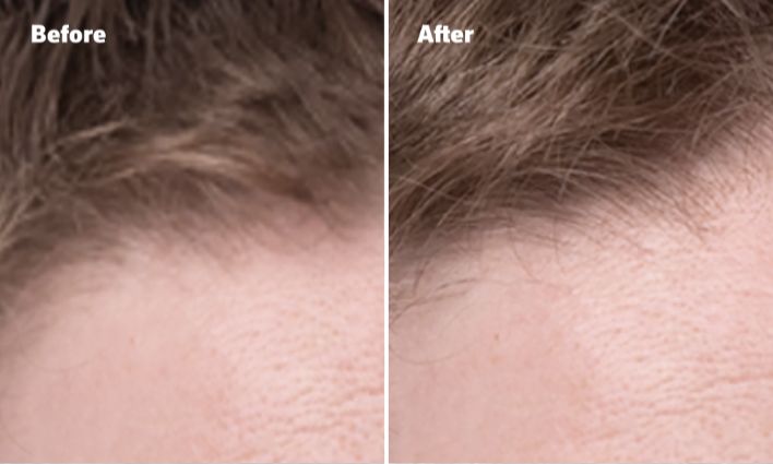 Before and After photo of man with light brown hair after one wash of Men's ROGAINE® Thickening 2 in 1 Shampoo + Conditioner.