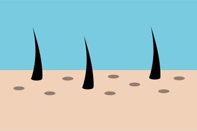 Scalp with few hairs, showing the causes  hair loss.