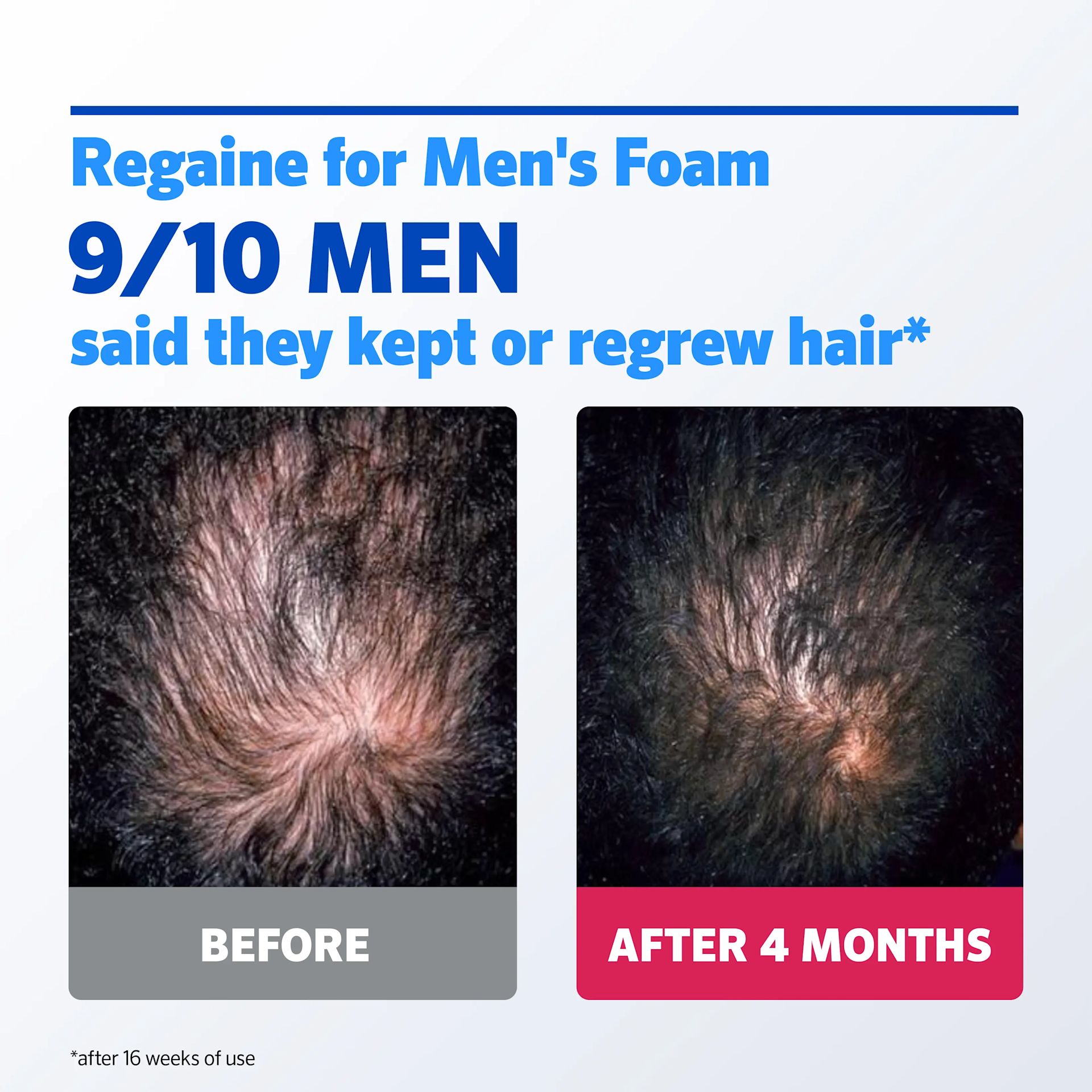 REGAINE® FOR MEN EXTRA STRENGTH SCALP FOAM FOR HAIR REGROWTH