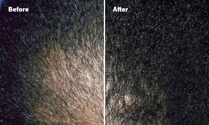 Before and After image, top of man's scalp is visible due to balding. Before and After image, top of man's scalp is visible due to balding.