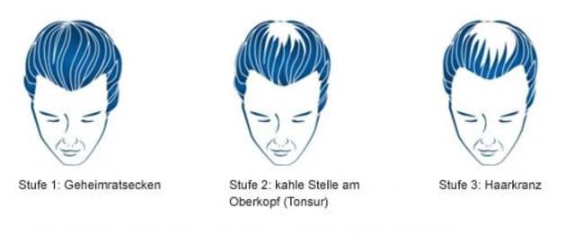 Haarausfall 3 Stufen bei Männern