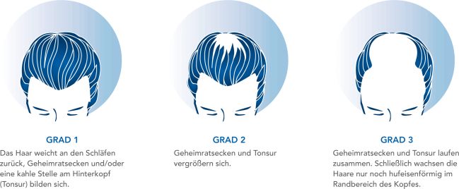 Haarverlust nach Hamilton Norwood Skala. Grad 1: Das Haar weicht an den Schläfen zurück. Grad 2: Geheimratsecken und Tonsur vergrößern sich. Grad 3: Geheimratsecken und Tonsur laufen zusammen. Haare wachsen nur noch hufeisenförmig im Randbereich des Kopfes
