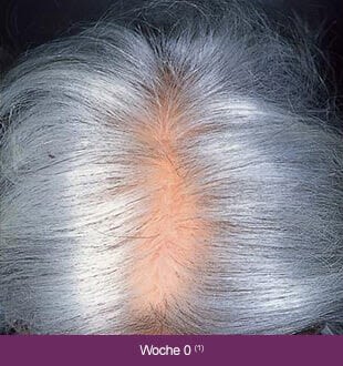 Regaine Frauen – Therapieverlauf nach 0 Wochen: Lichtes, graues Haar.