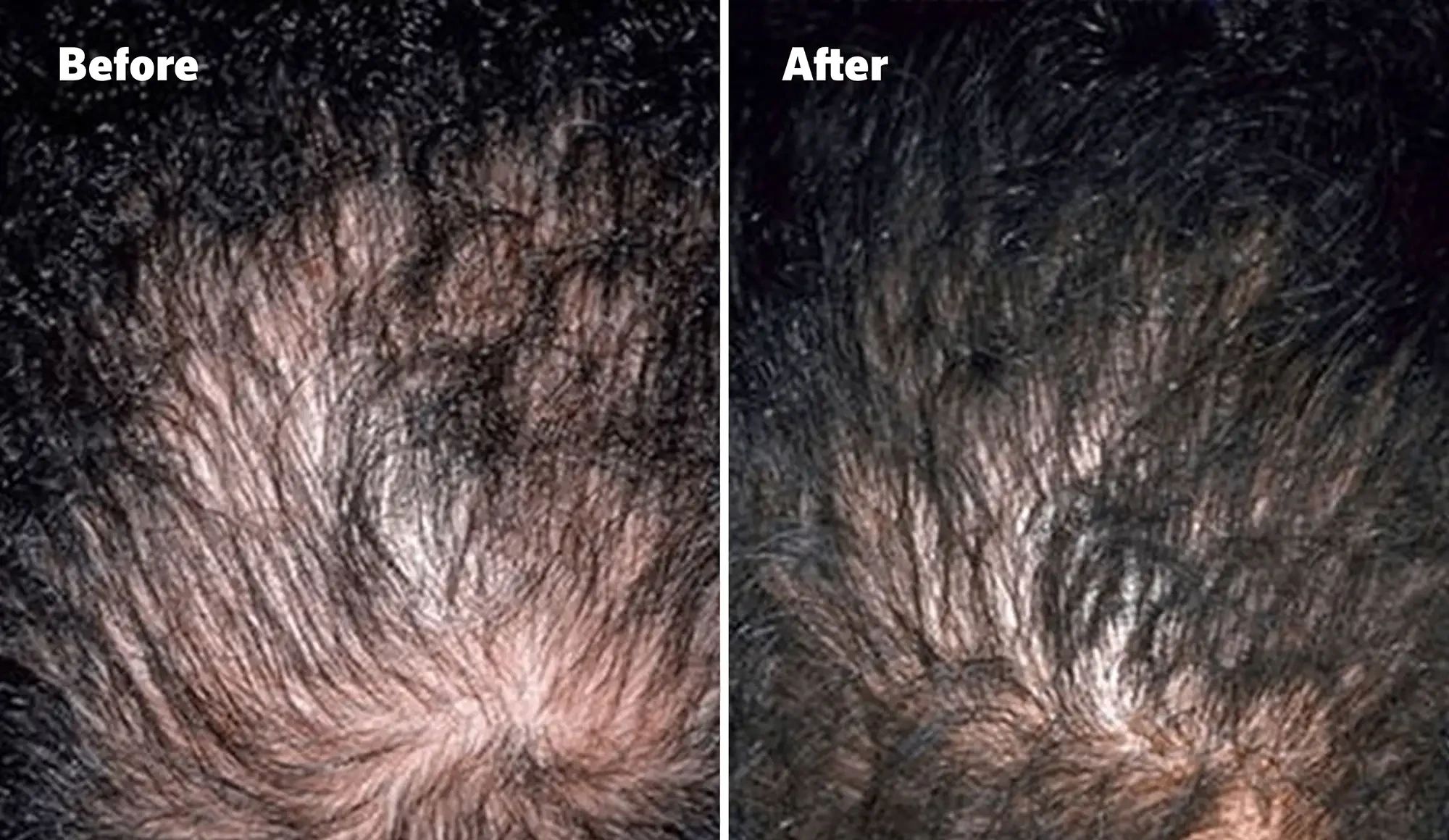 top of man's scalp is visible due to balding. Before and after image, top of man's scalp is visible due to balding.