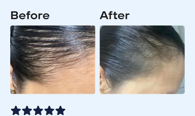 Before and After image, top of woman's scalp showing signs of hair regrowth.