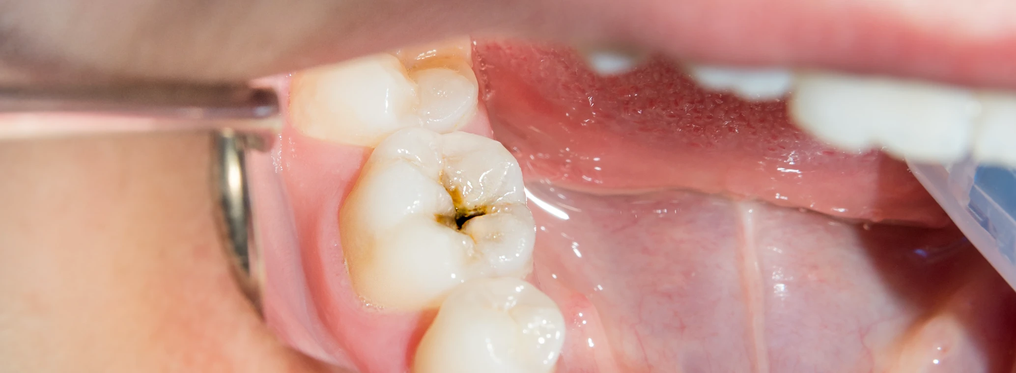 Close up of a human rotten carious tooth at the treatment stage in a dental clinic | Crest
