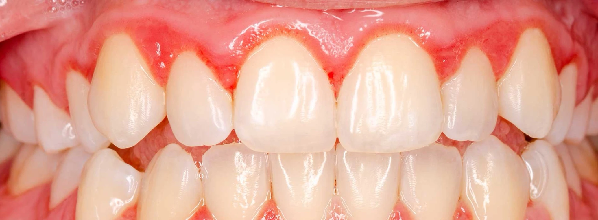 Close up grimacing teeth with bleeding gums