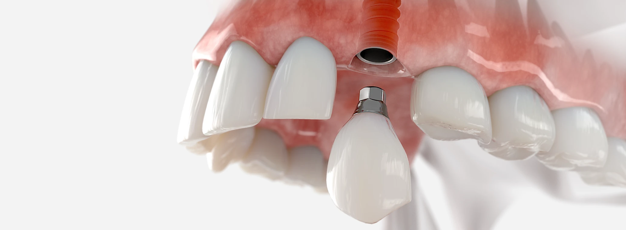 Dental Implants: Advantages and Disadvantages  