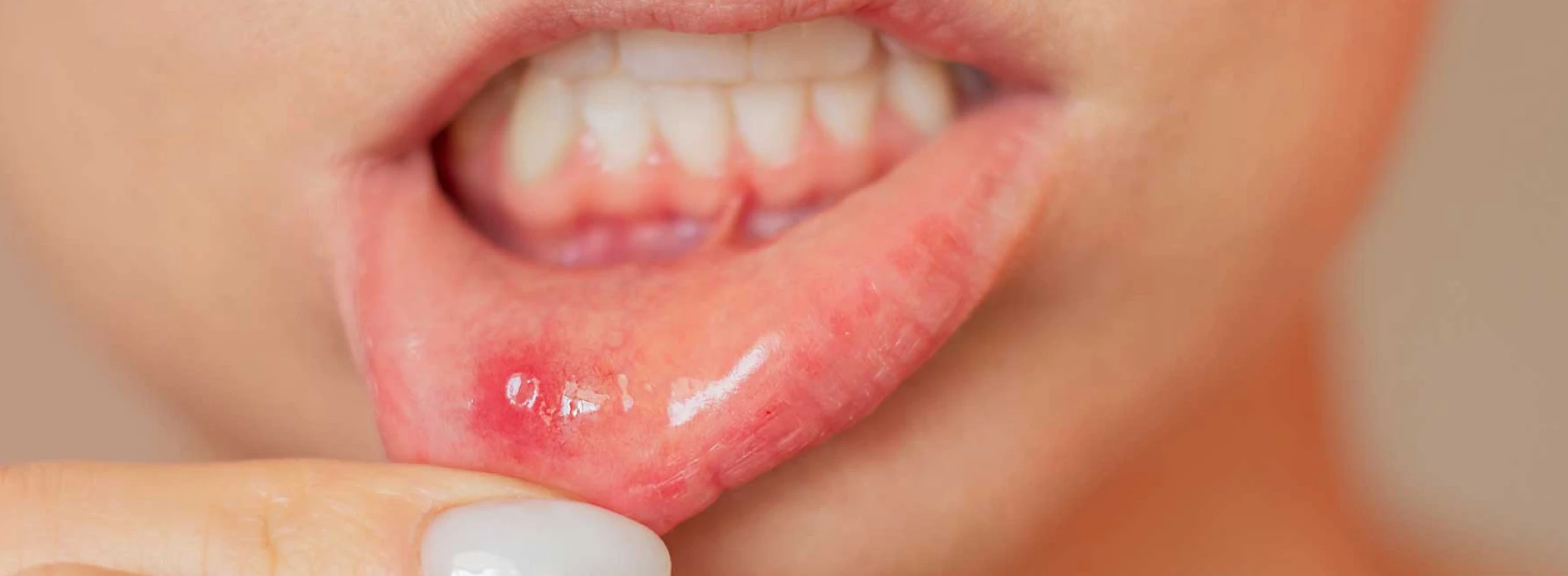 Woman pulling her lower lip down to show a bump on the inside