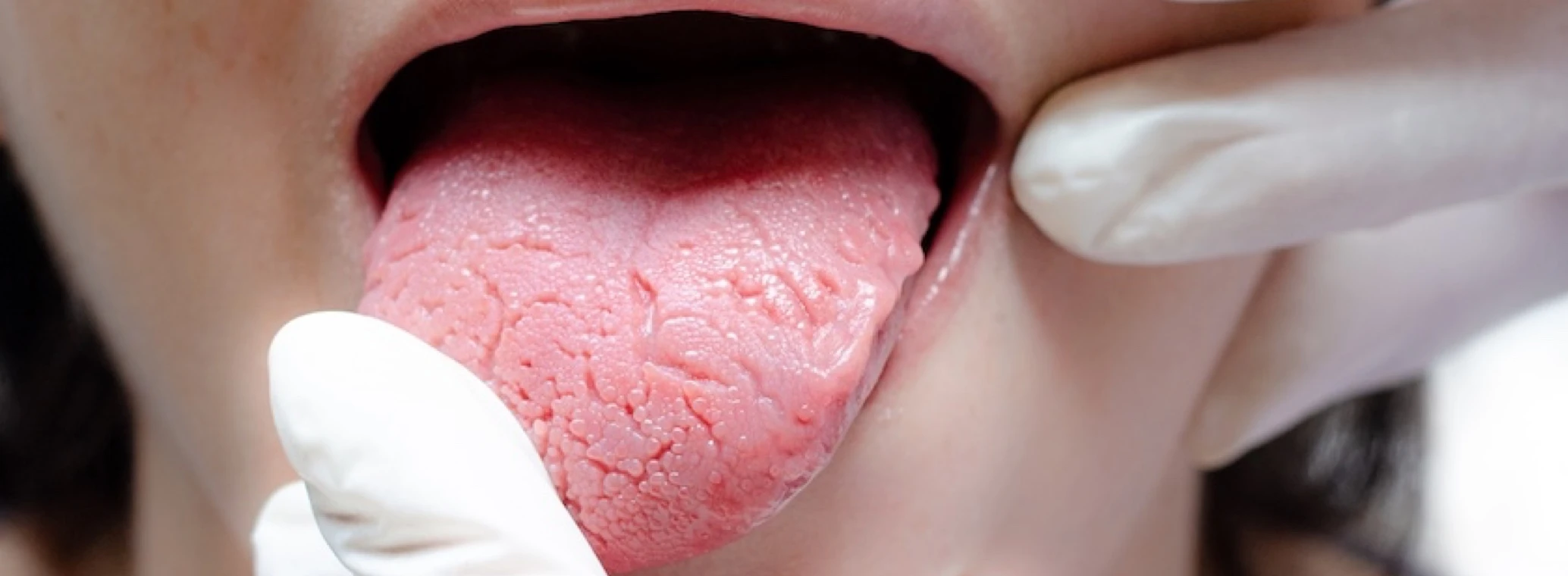 Patient sticking out her tongue showing symptoms of geographic tongue
