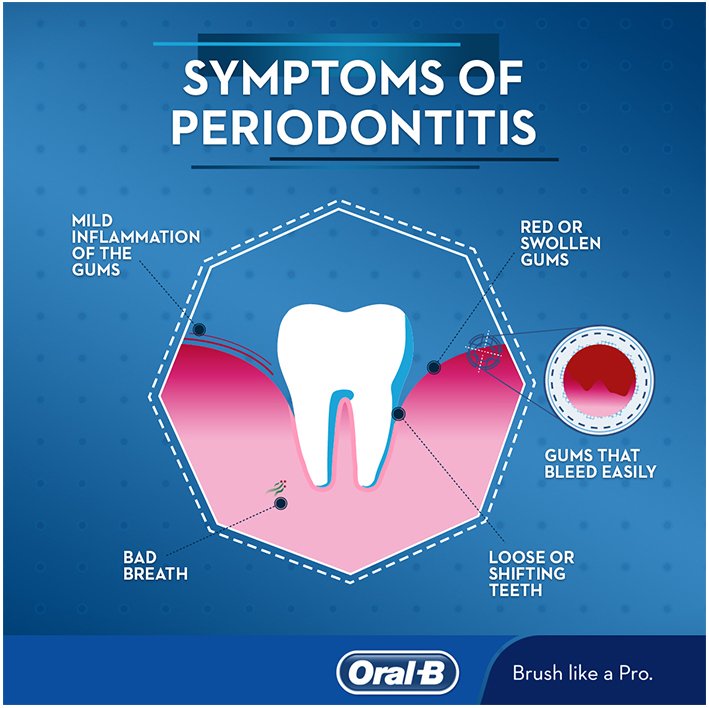  Graphic depicting periodontitis symptoms