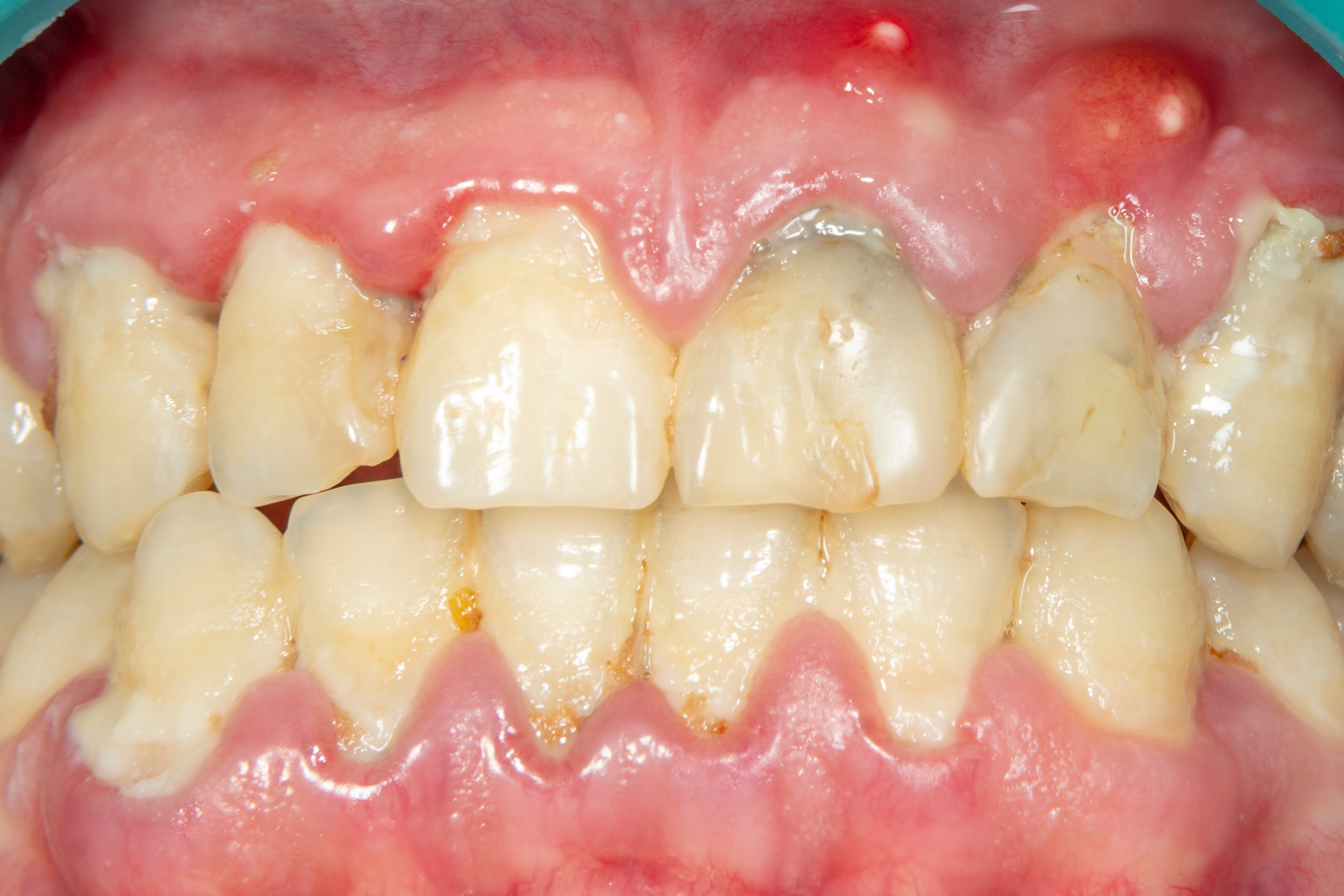 Close-up of teeth experiencing trench mouth symptoms | Crest
