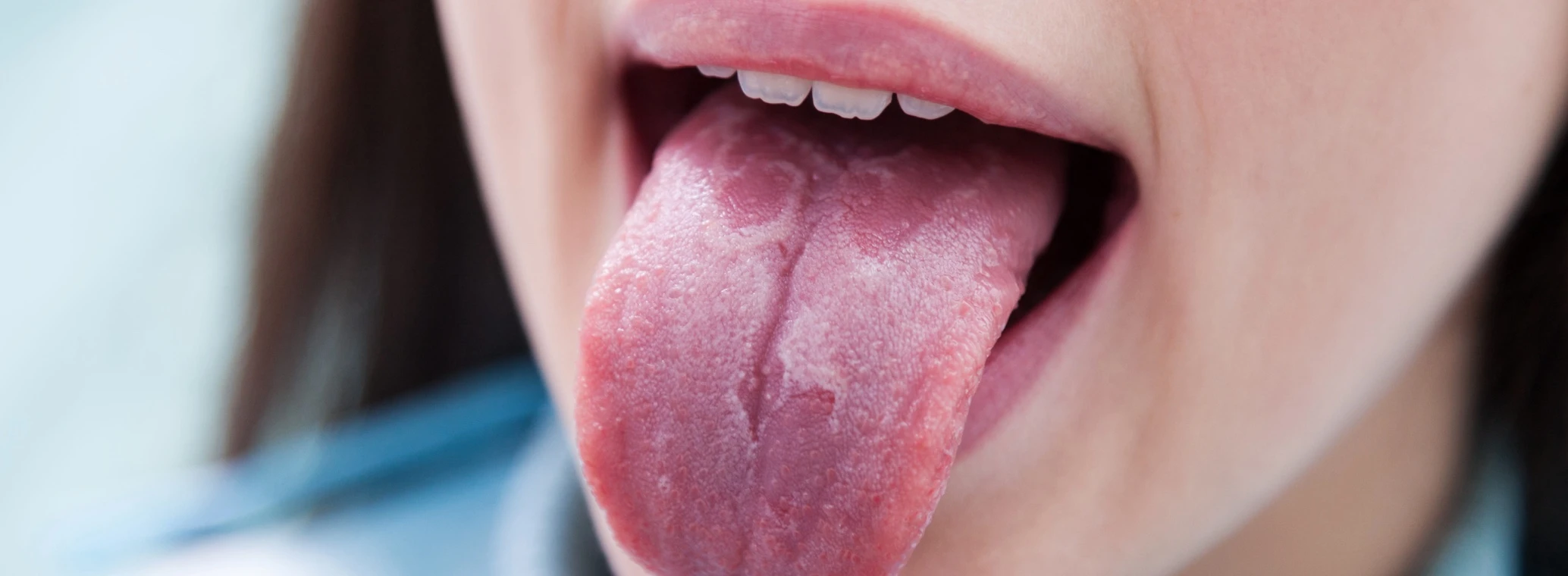 Close-up of a young woman with glossitis tongue extending her tongue.