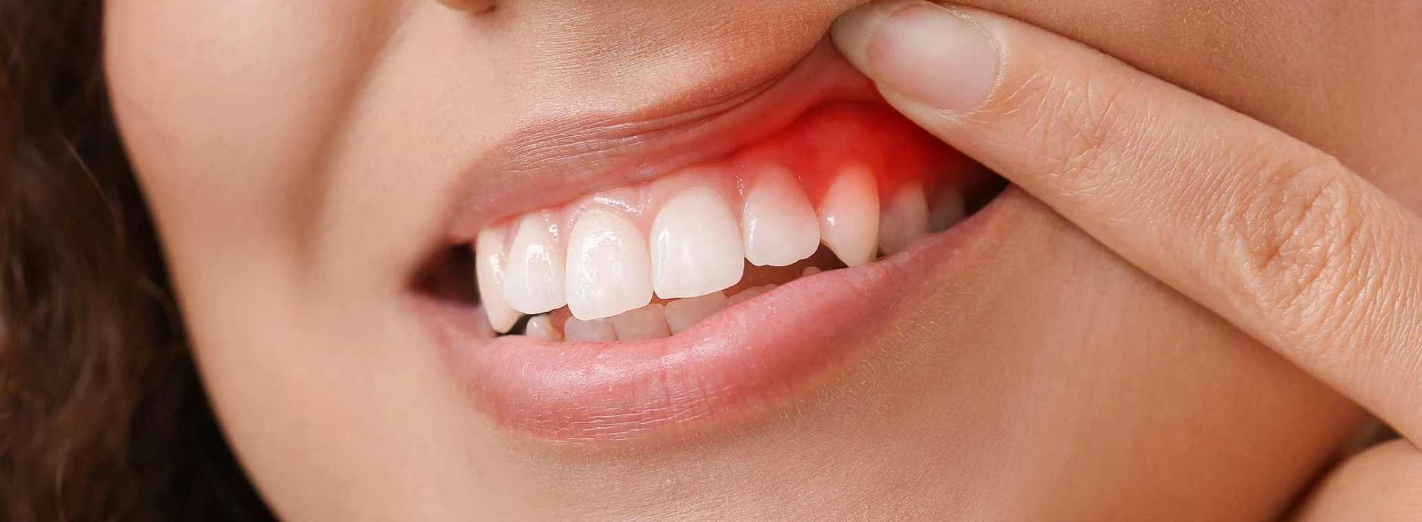 Image of red, inflamed gums I Crest