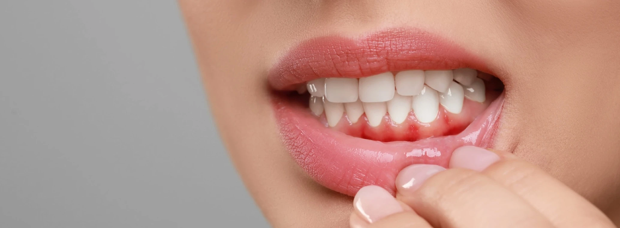 Woman revealing red, swollen gums as a sign of early-stage gum disease (gingivitis)