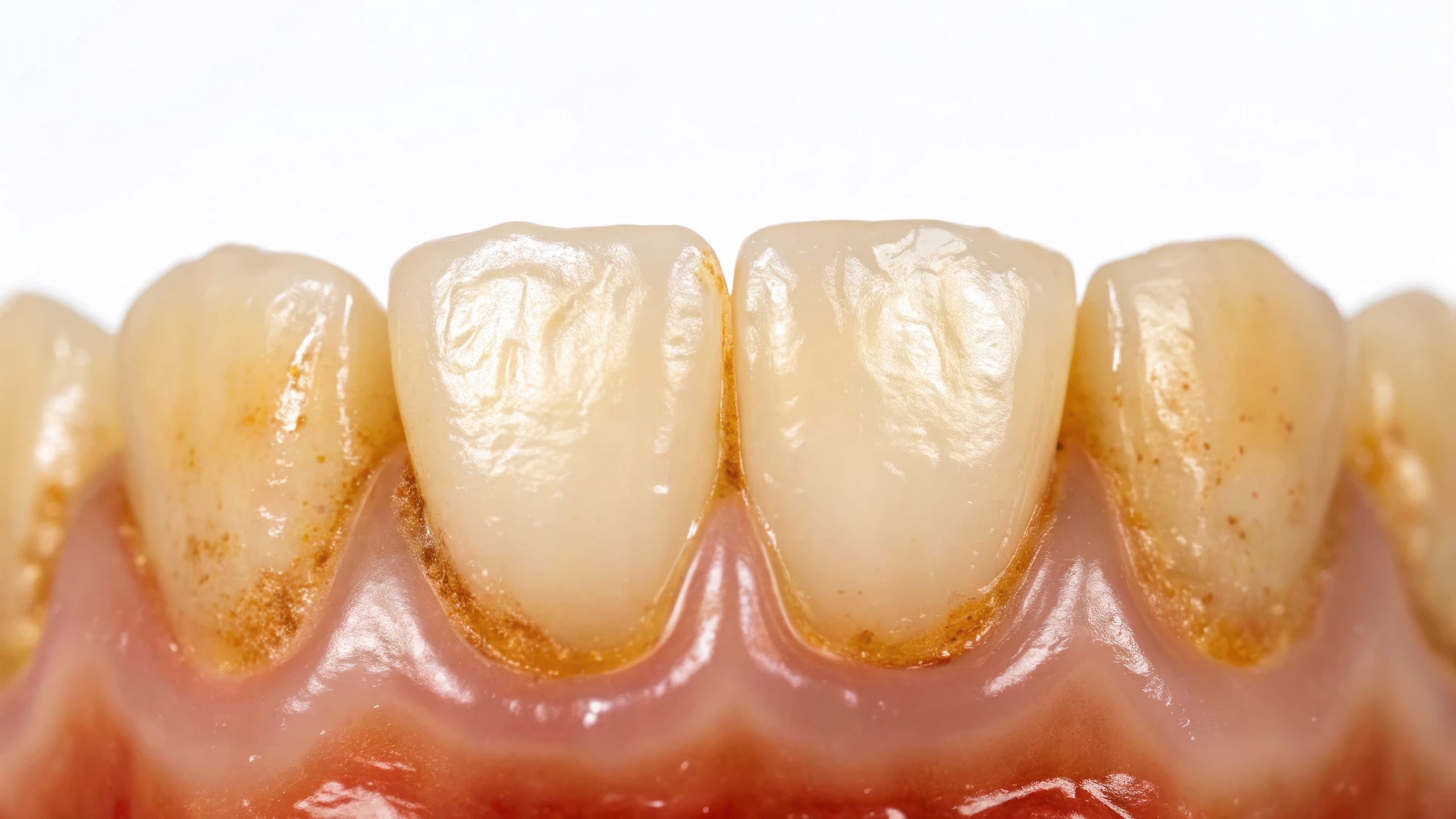 Plaque buildup on teeth that can cause gingivitis