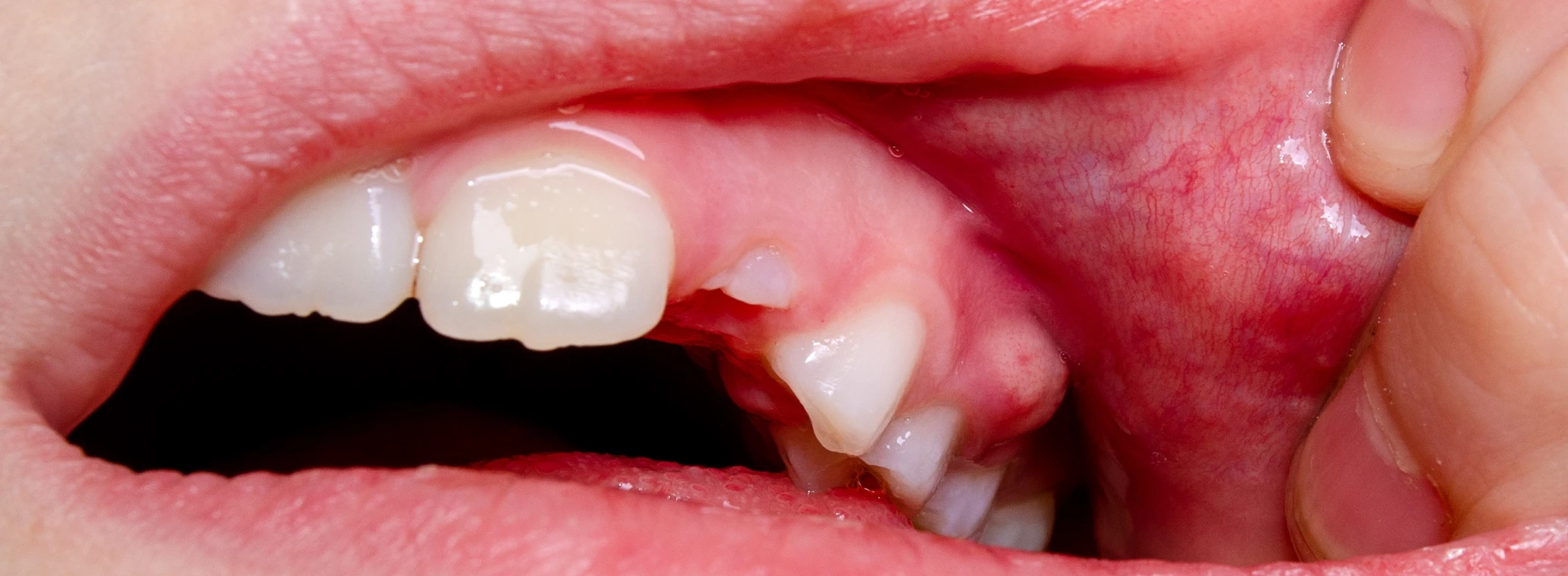 Image of a gum boil above a tooth | Crest