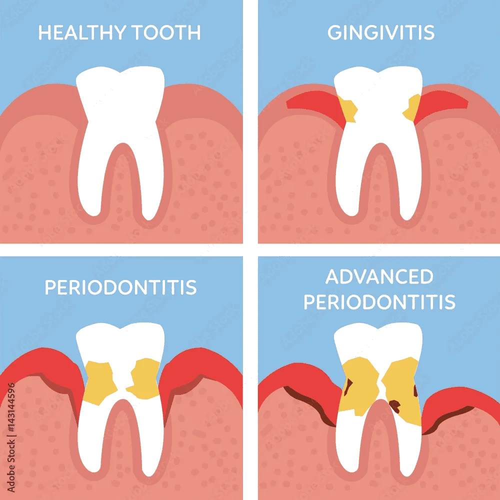 Visual progression of gum disease from healthy tooth to gingivitis, periodontitis, and advanced periodontitis 