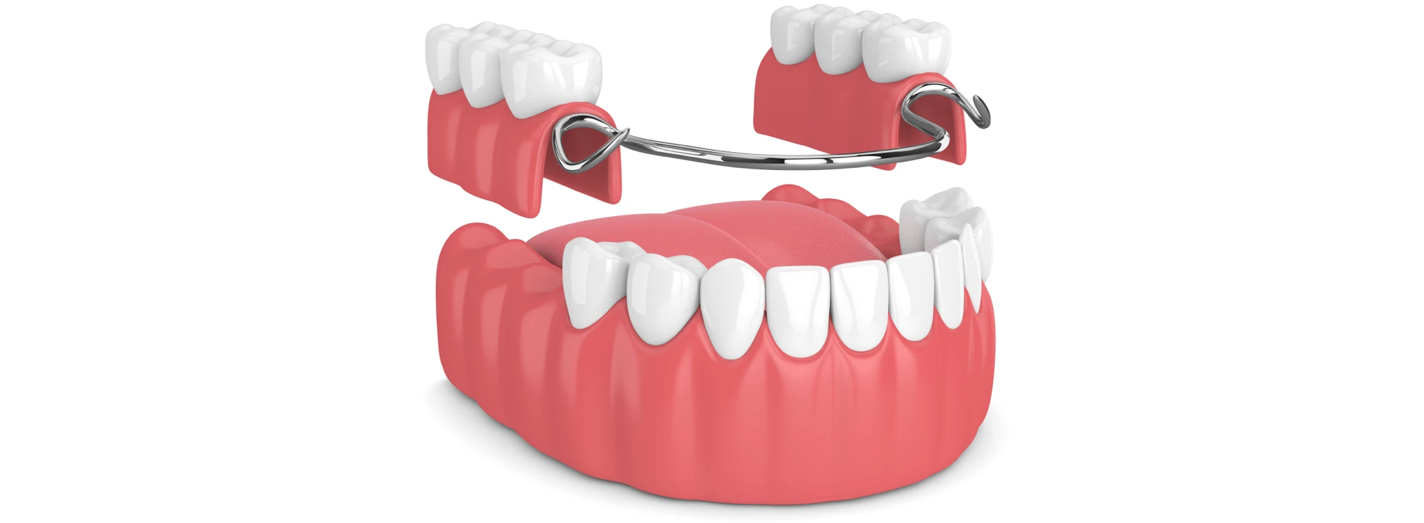 Display of partial dentures and how to insert them