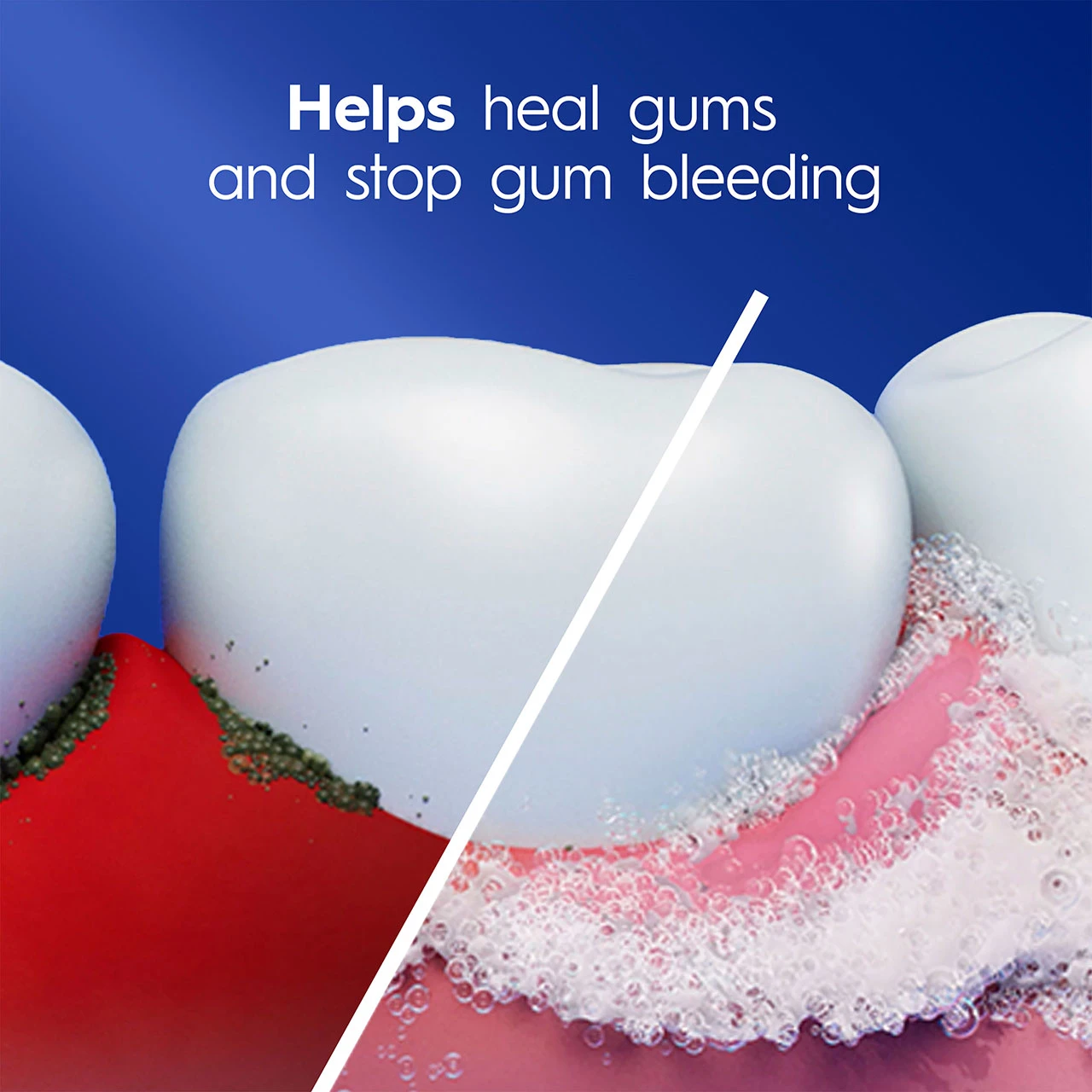 Helps heal gums and stop gum bleeding