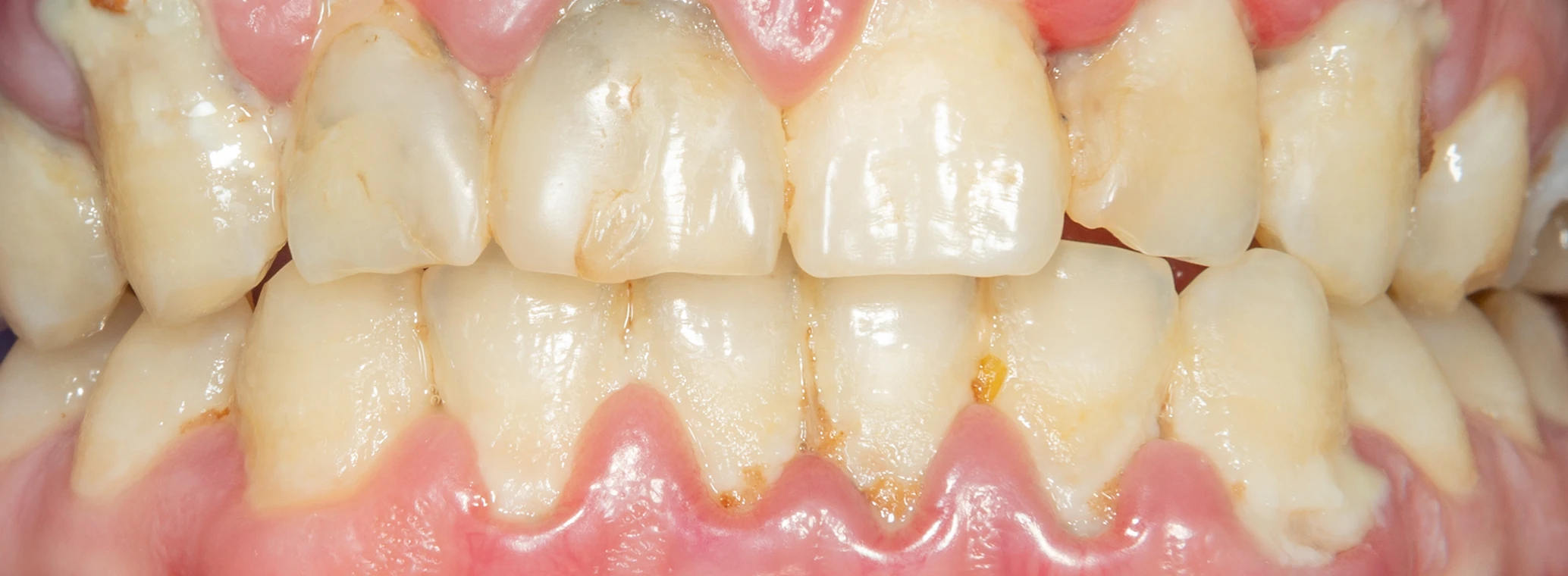 Person with bleeding and inflamed gums