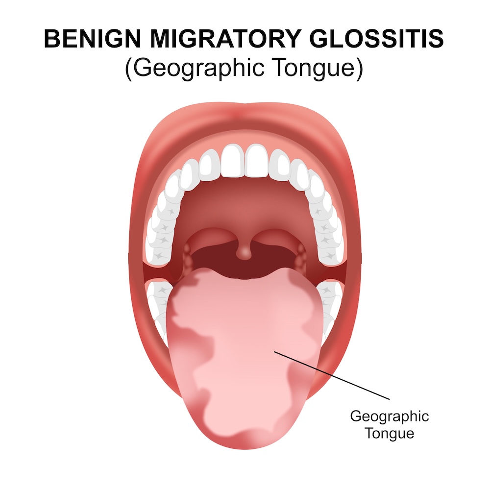 Illustration of geographic tongue