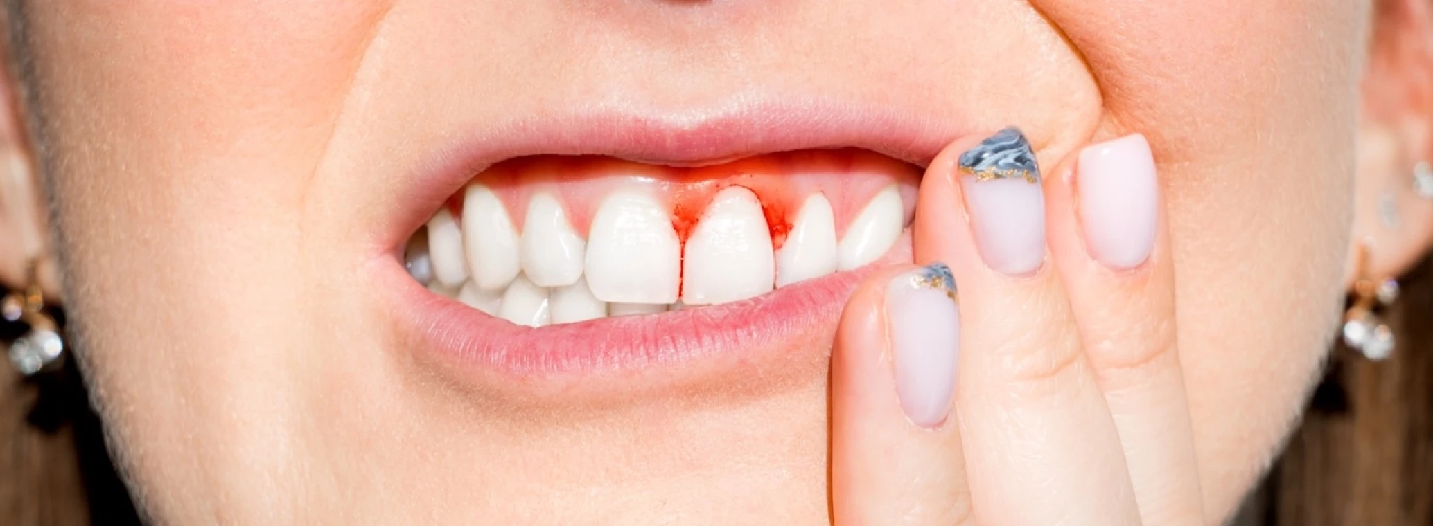 Illustration of bleeding gums