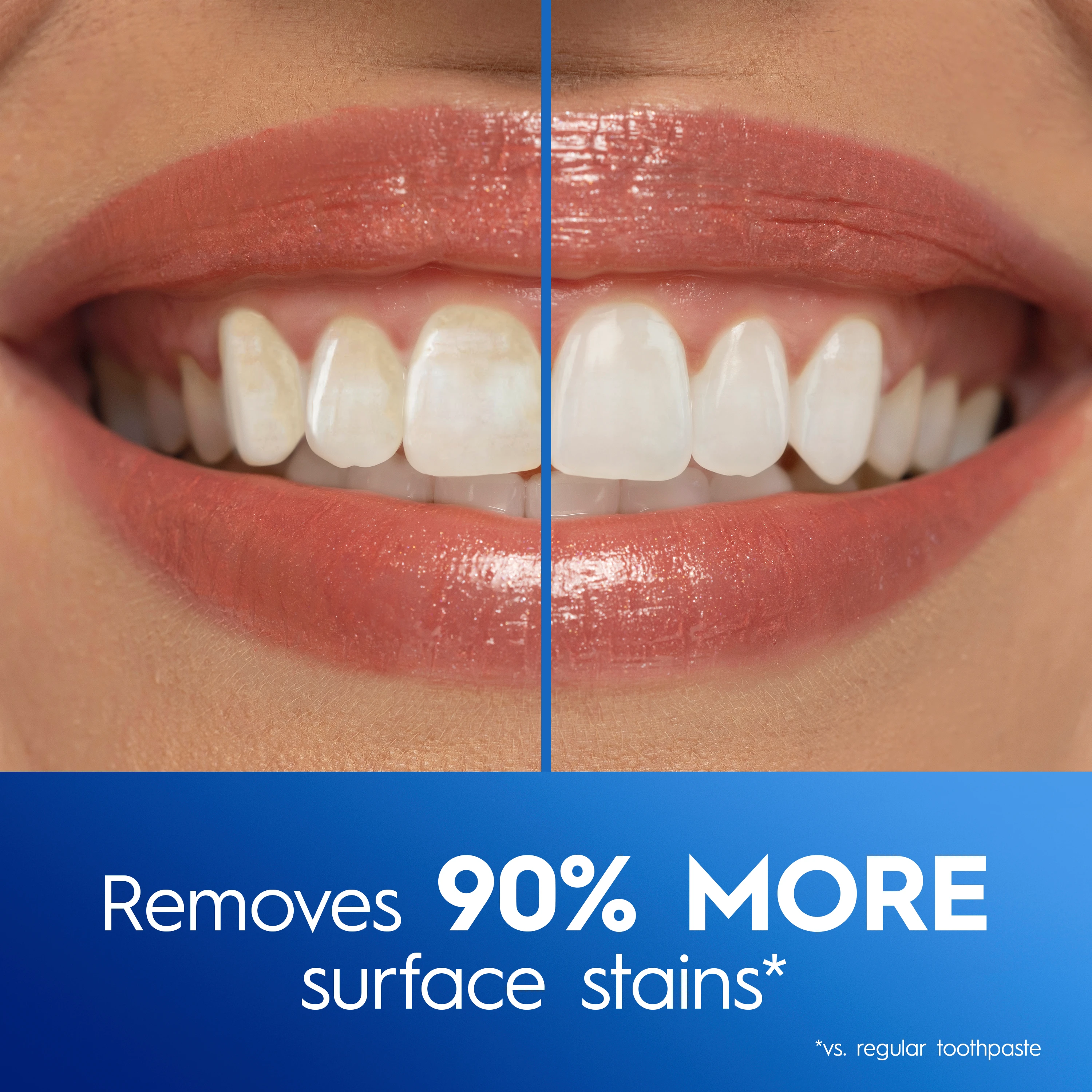 Side by Side image of teeth. Removes 90% more surface stains vs. regular toothpaste
