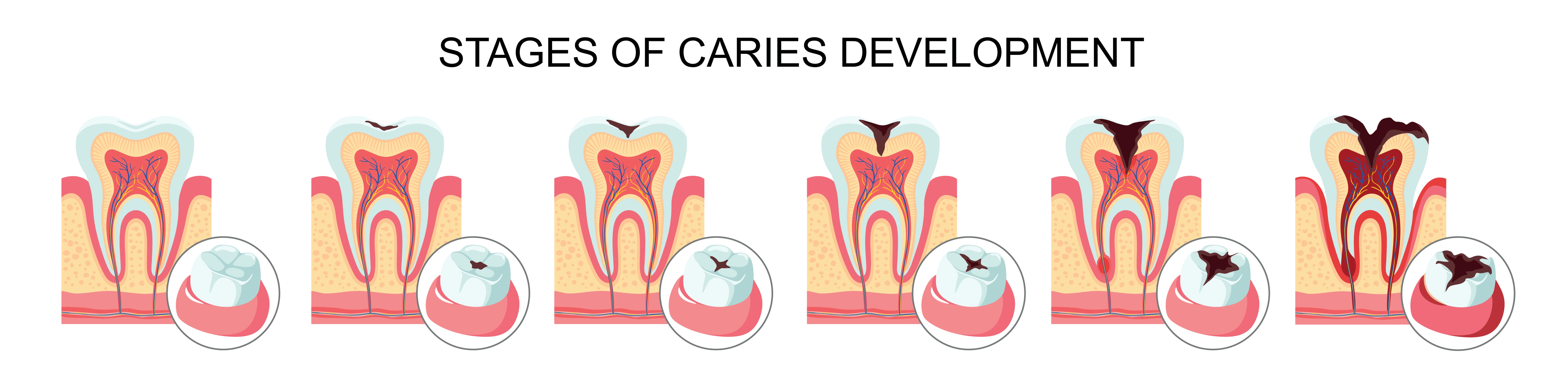 Tooth structure and types of caries vector illustration | Crest