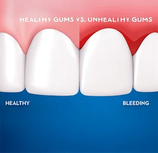 Bleeding Gums: Causes, Treatments, and Prevention