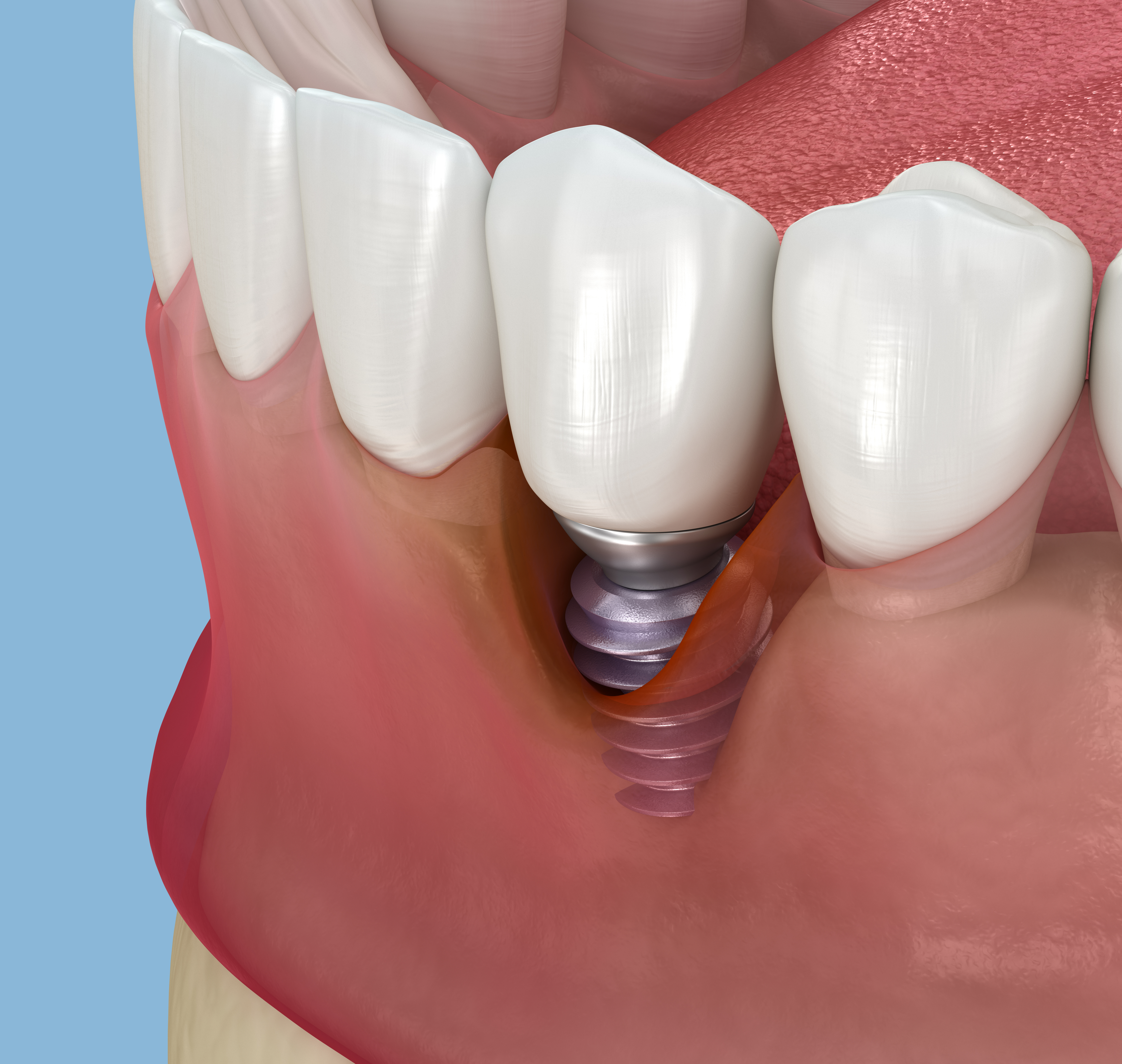 Close-up of dental implant being placed into the bone