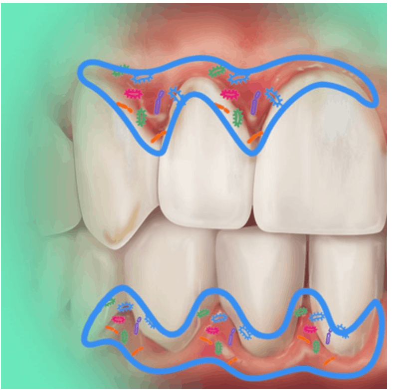 Illustration of bacteria buildup along the gums causing inflammation