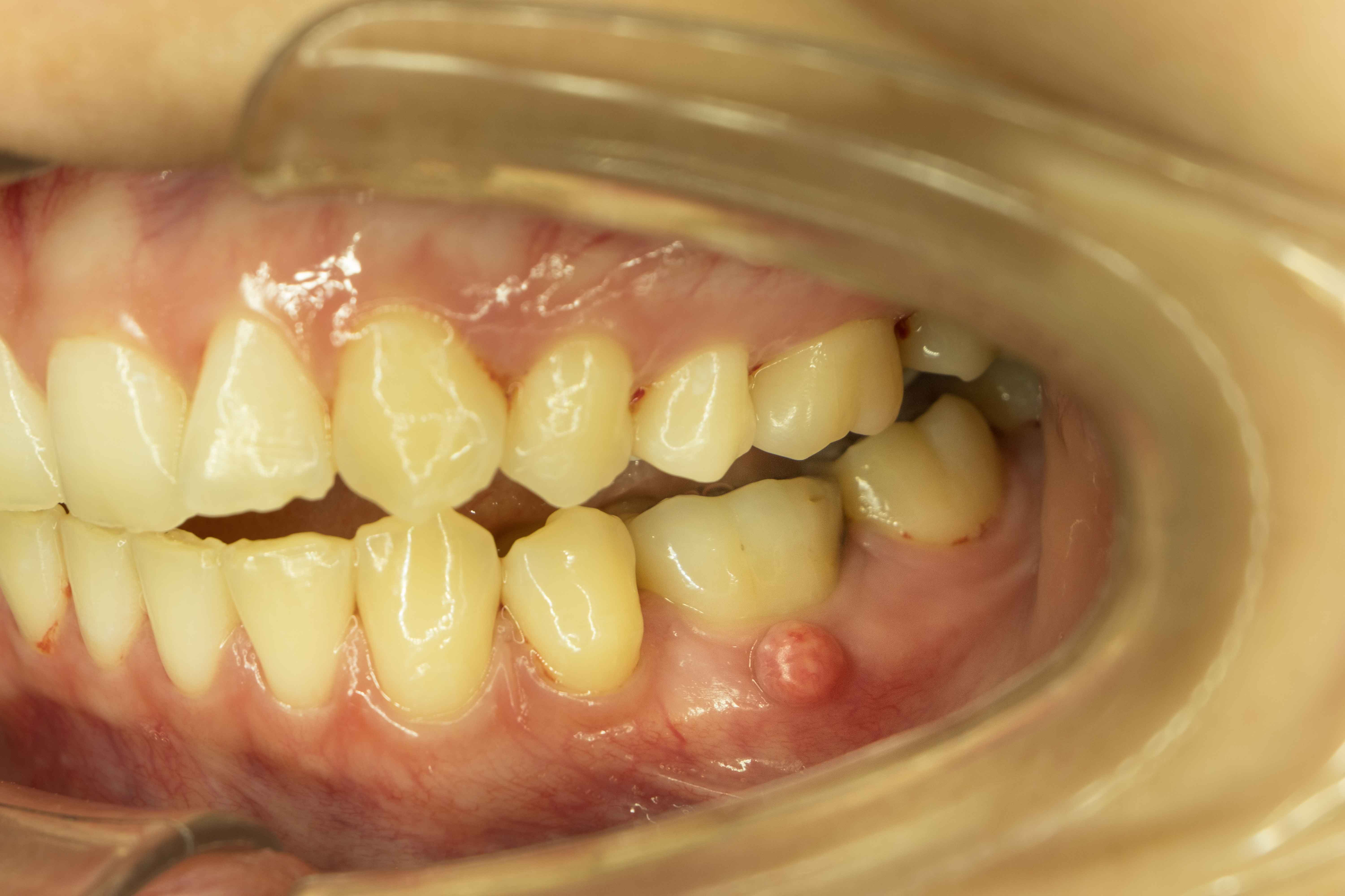 Gum abscess below lower teeth | Crest