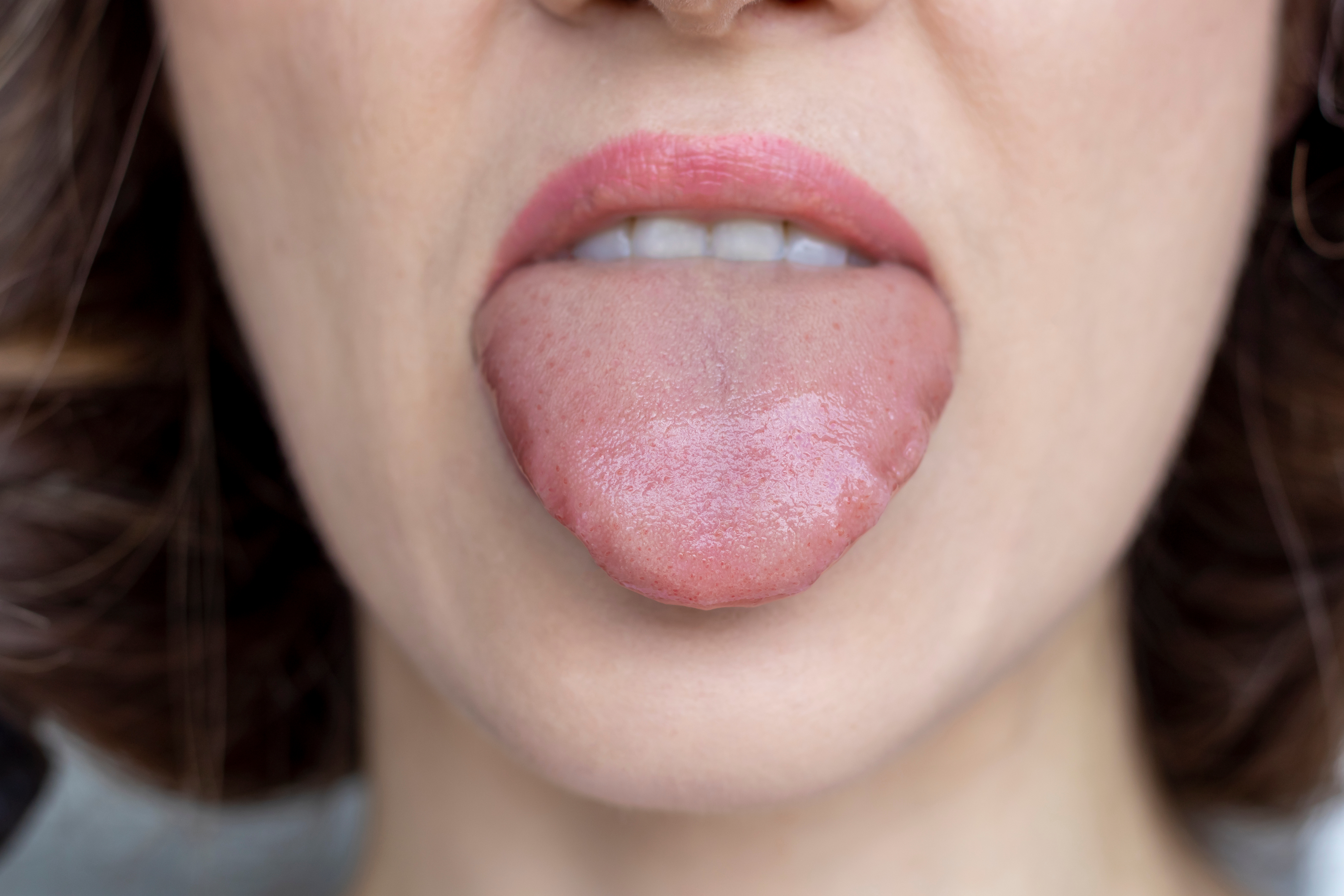 Atrophic Glossitis