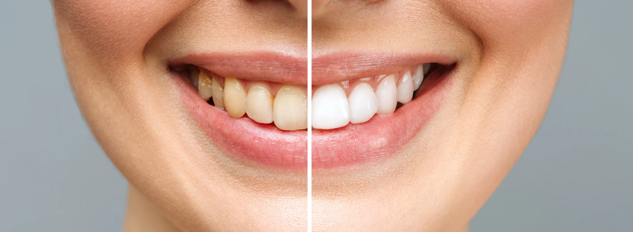 Yellow teeth causes