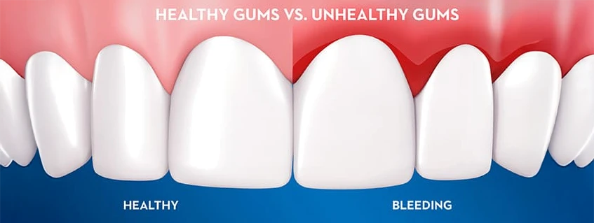 Visual depiction of healthy gums versus unhealthy gums