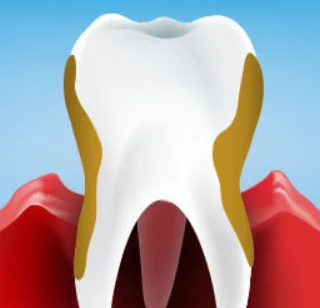 Graphic depicting a single tooth with plaque buildup