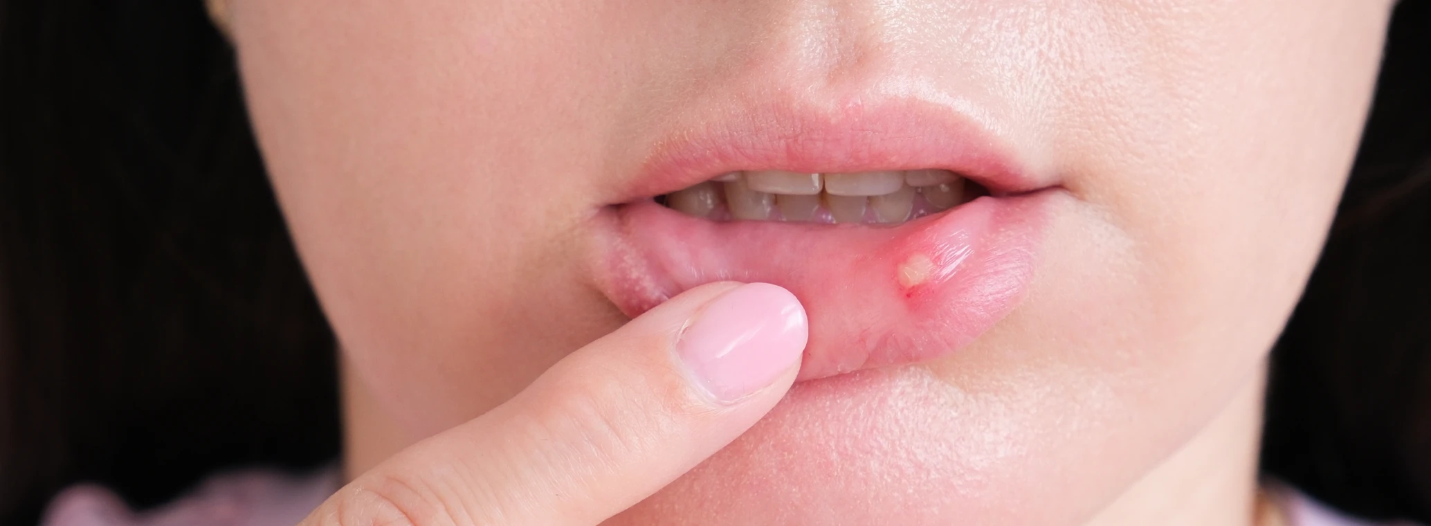 A woman has stomatitis on her lip