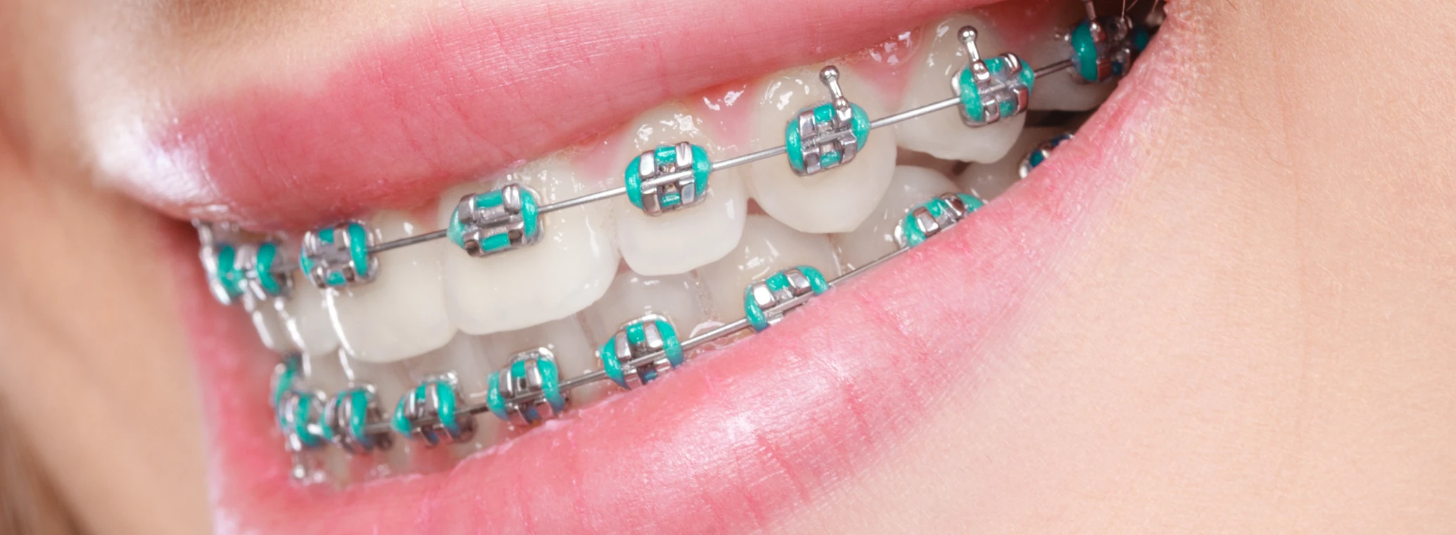 How to Pick the Best Colors for Your Braces 