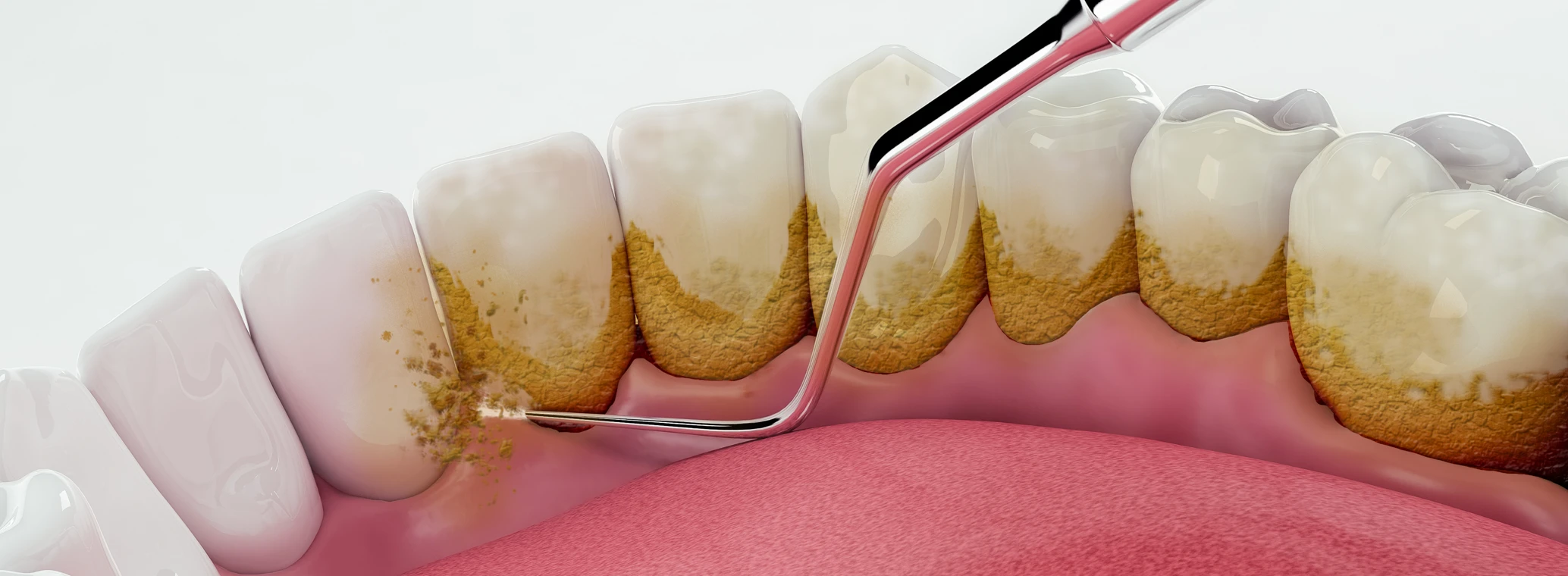 Image of tartar buildup on teeth | Crest