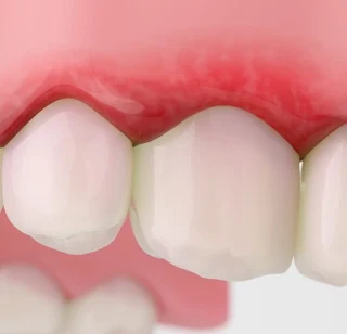 Close-up image showing receding gums