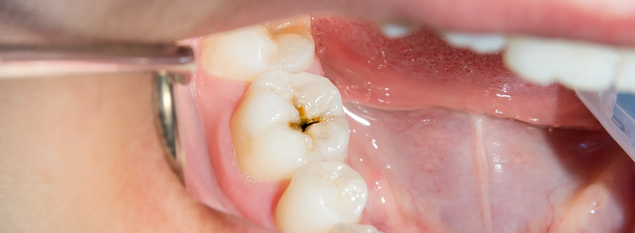 What are Dental Caries? Causes, Symptoms, and Treatments