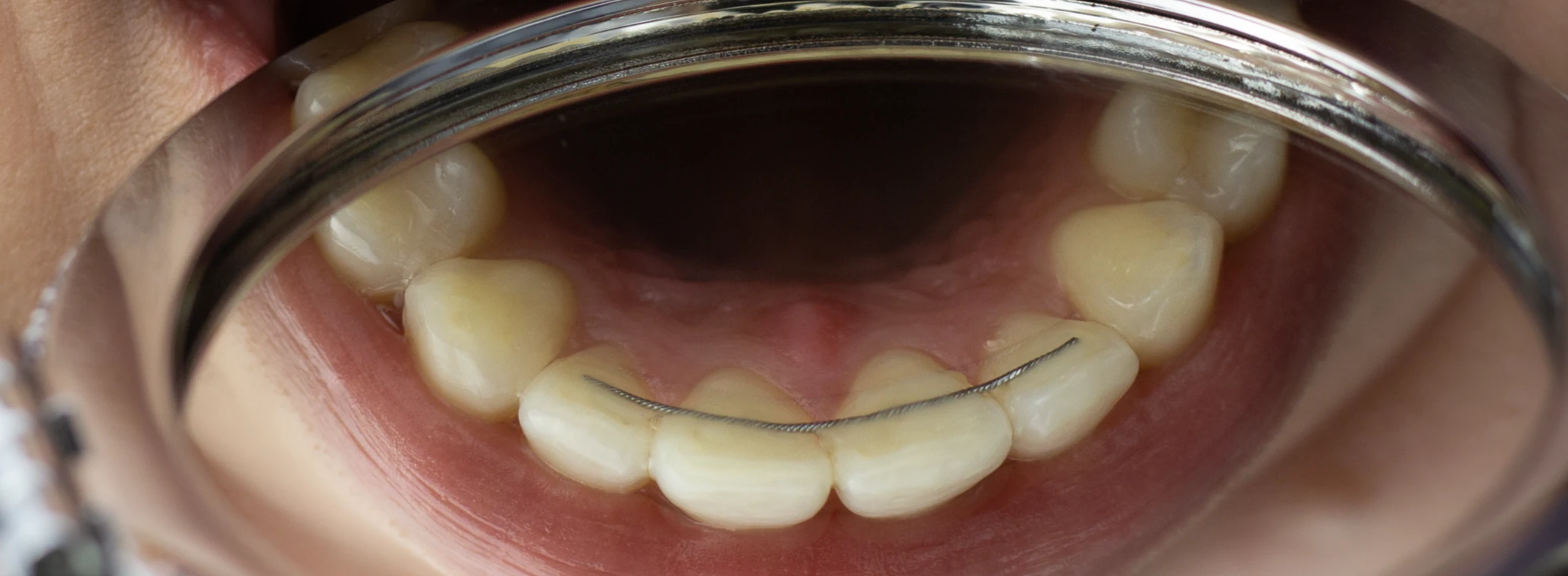 Close-up of person wearing retainers on the back of their bottom teeth 