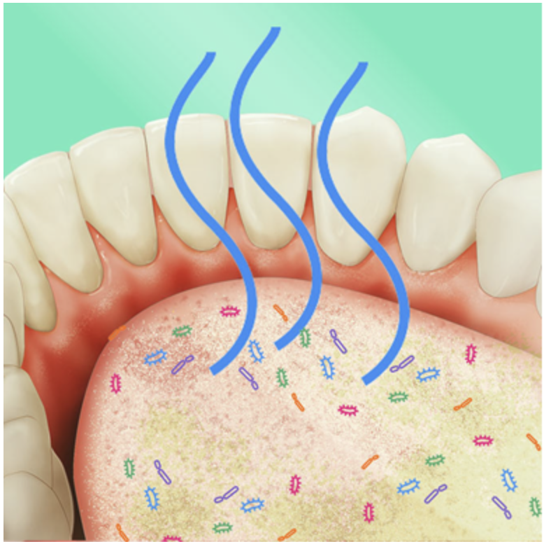 Graphic illustrating bacteria in the mouth contributing to bad breath