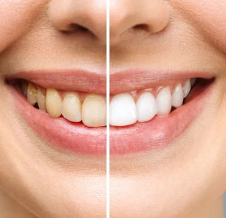 Yellow Teeth: Causes and How to Whiten Teeth