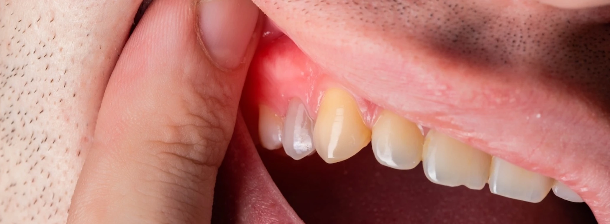 Close-up image of a person pulling back their lip to expose their gums and teeth. Gum area is red and inflamed, suggesting possible cyst. 