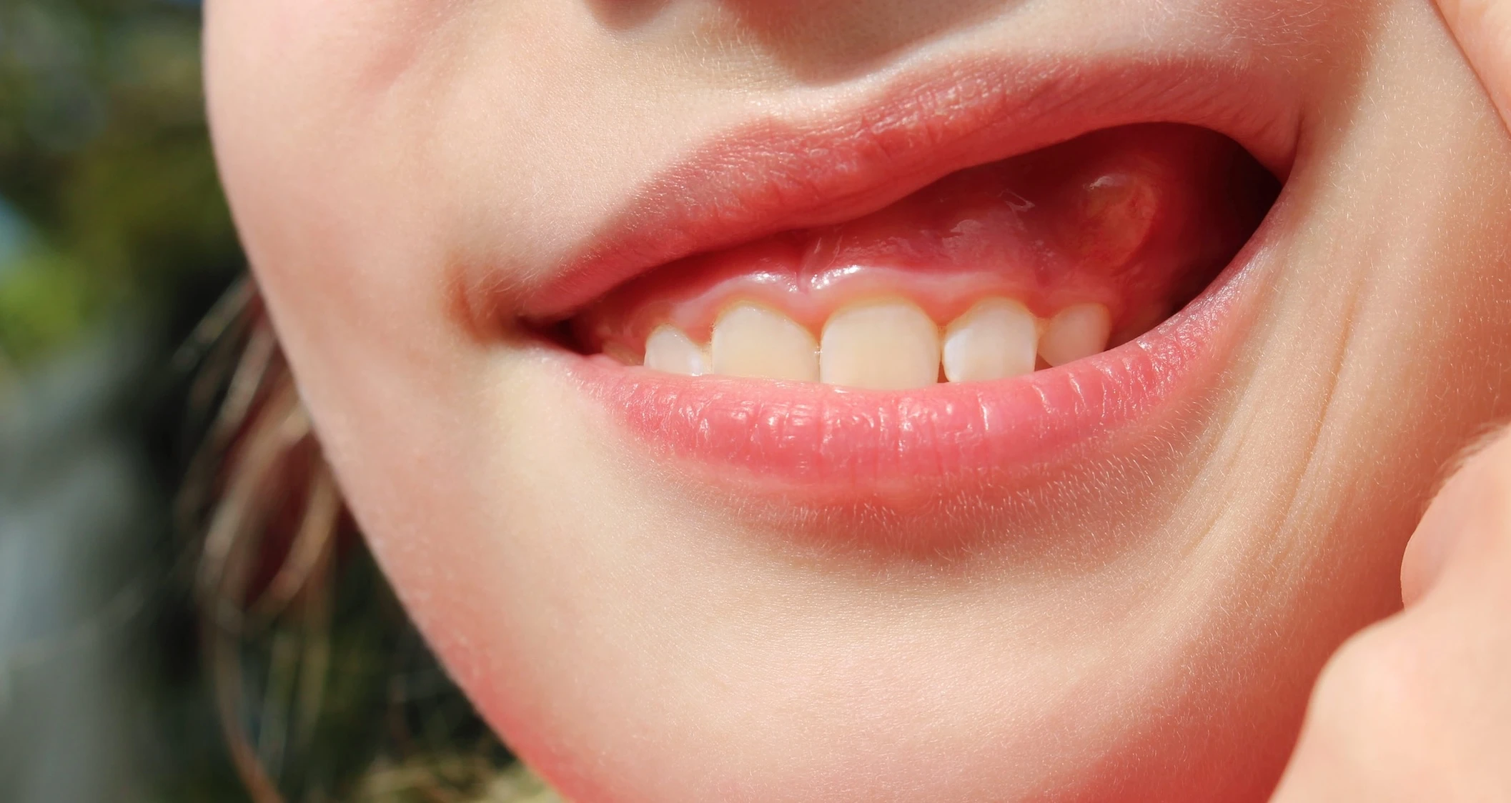 Image of a gum boil below a tooth | Crest