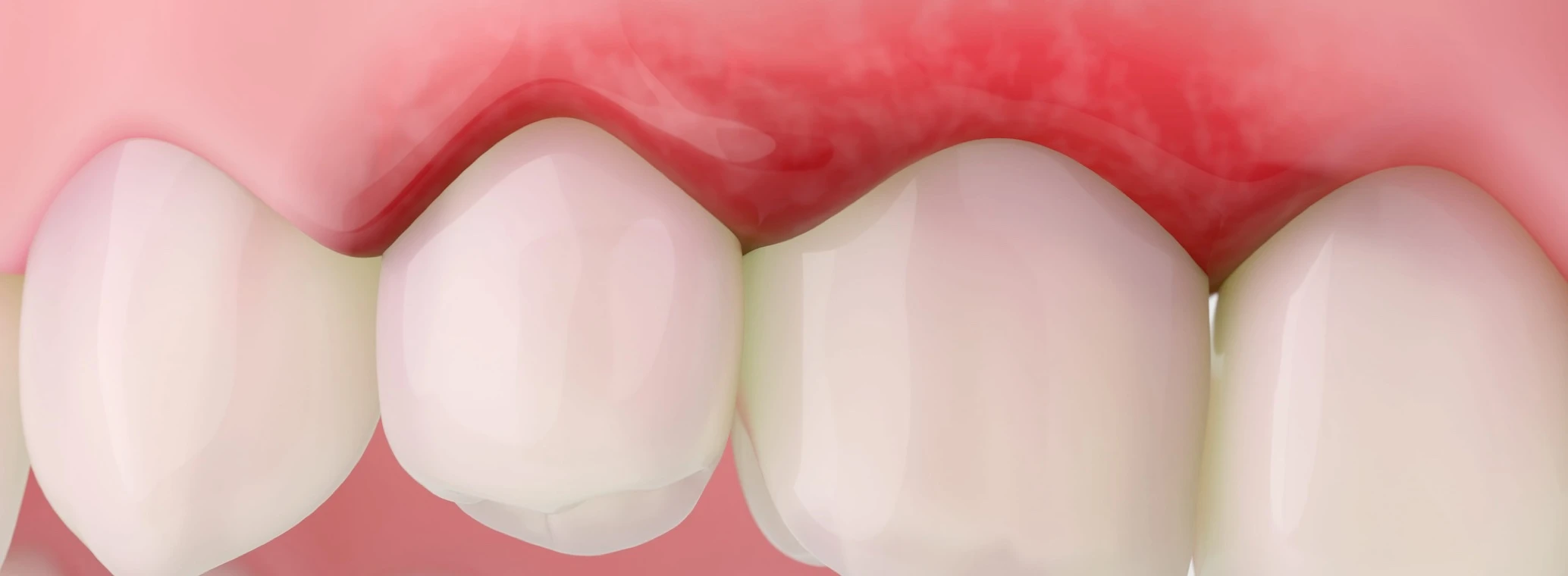 Close-up image showing receding gums